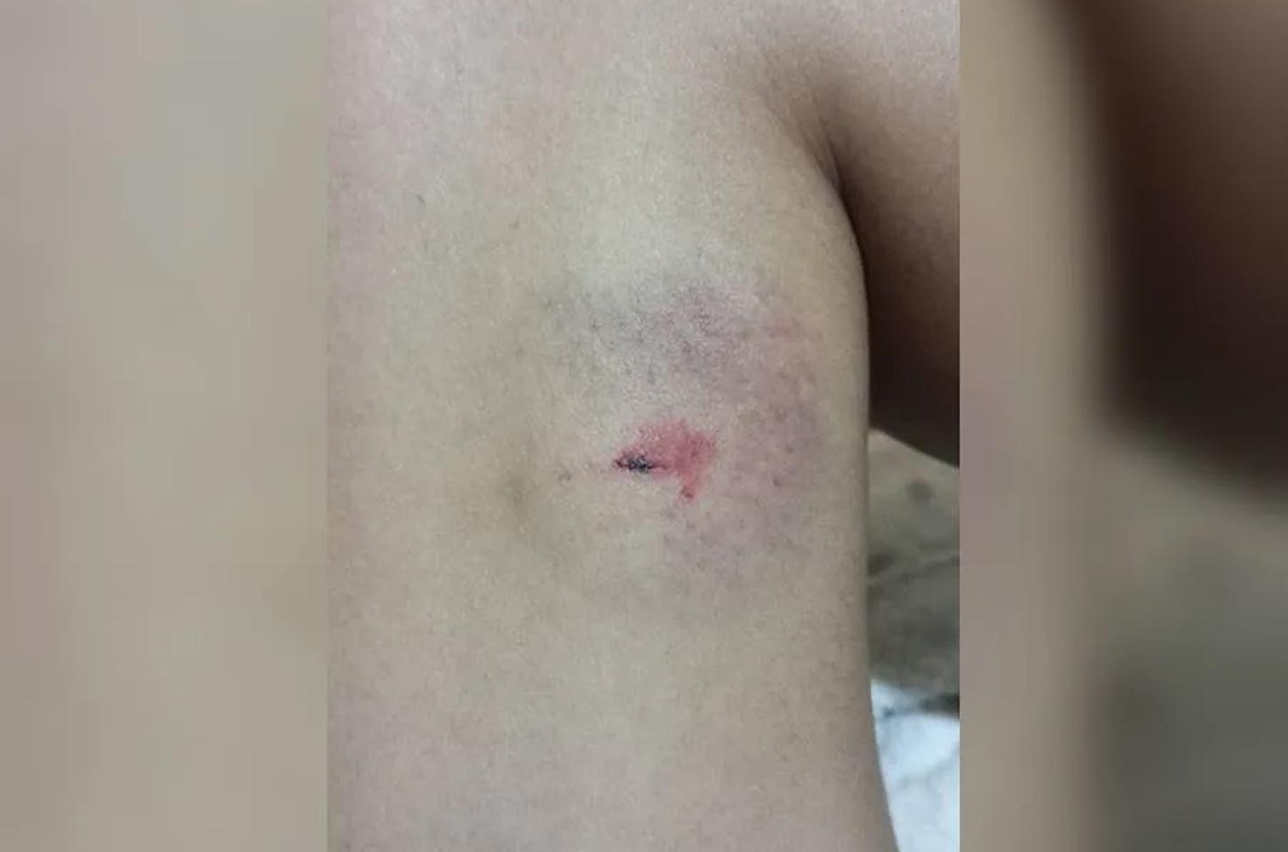 Adolescente de 16 anos é atacada por três cães próximo ao Mercado Fama, em Kaloré